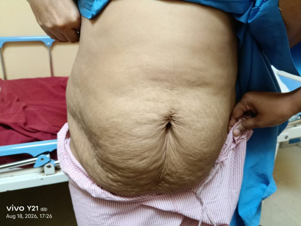 tummy tuck